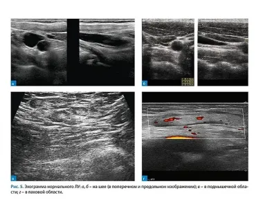 Лимфатические узлы в ультразвуковой диагностике